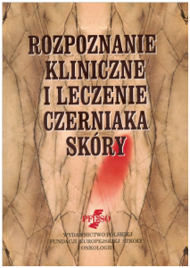 Rozpoznanie kliniczne i leczenie czerniaka skóry